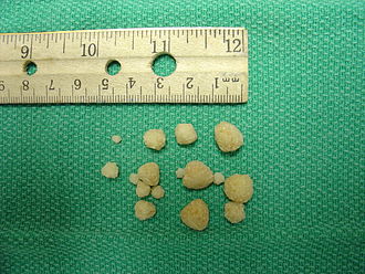 calcium oxalate stones next to ruler to show size